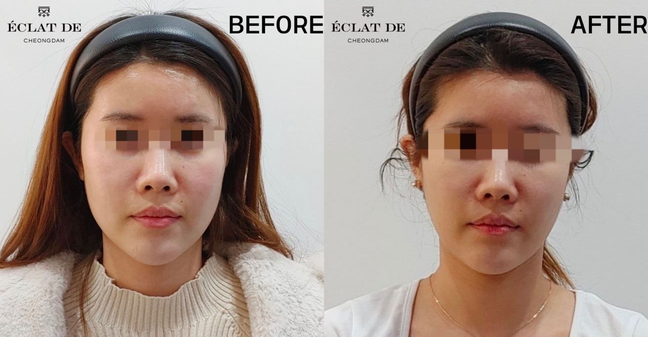 Oligio X – Before & After from Eclat De