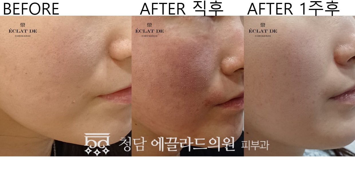 Res Novae Skin booster – Before & After from Eclat De