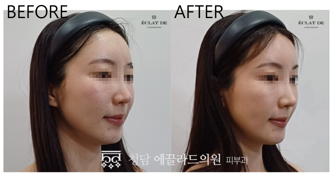 Thermage FLX 600 Shots- Before & After from Eclat De