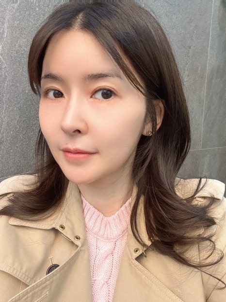 One Month After Painless Ultherapy 300 Shots