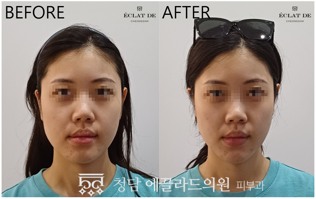 Titanium Lifting 80KJ – Before & After from Eclat De