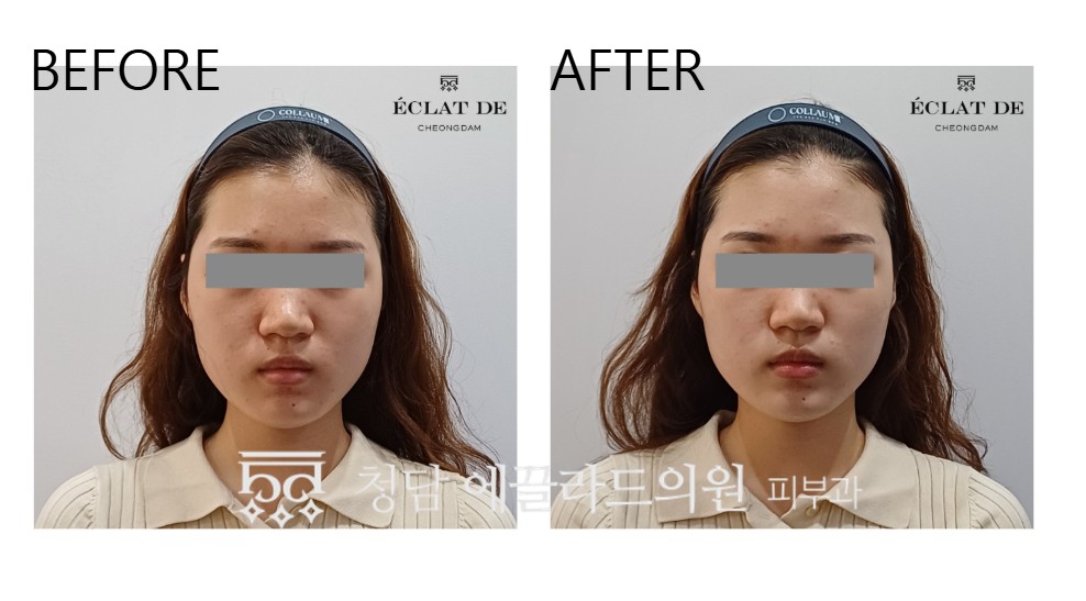 Accu Toning- Before & After from Eclat De