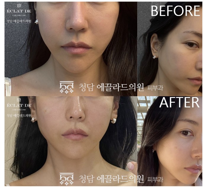3D Modeling Volume Filler - Before & After from Eclat De