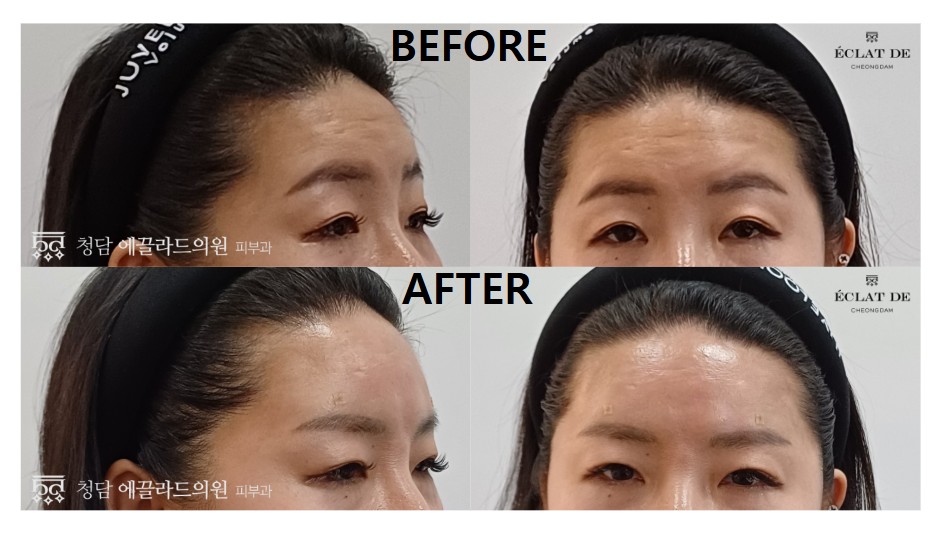 Forehead Filler - Before & After from Eclat De