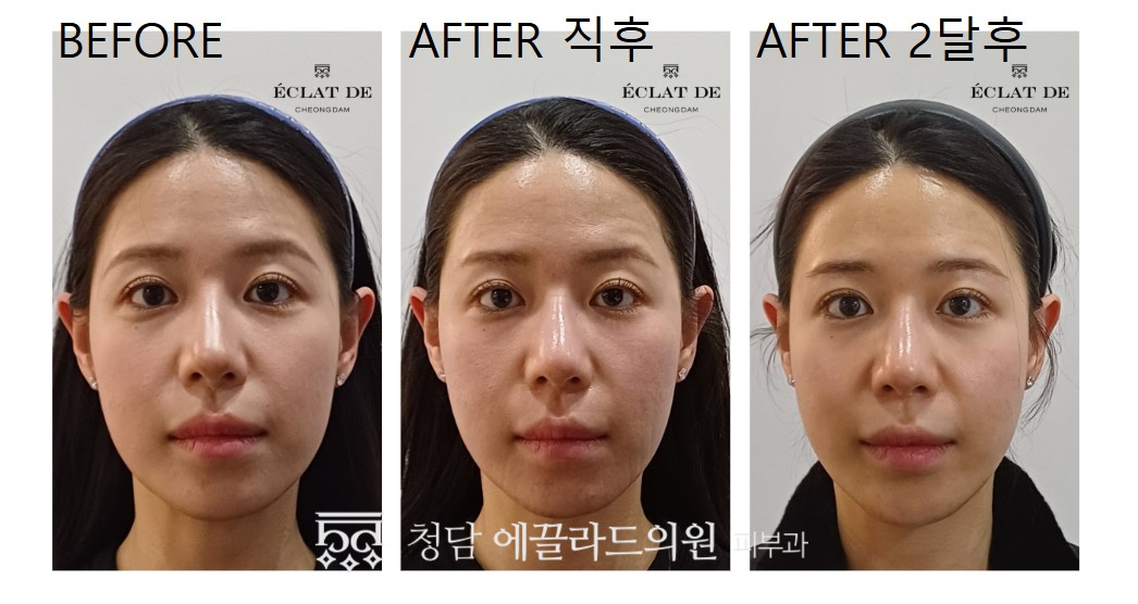 UltraClear- Before & After from Eclat De
