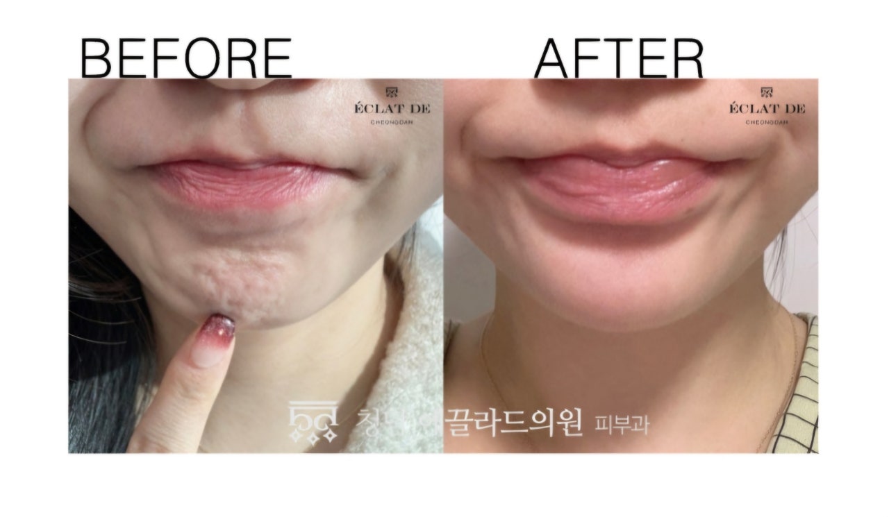 Pebble Chin Botox - Before & After from Eclat De
