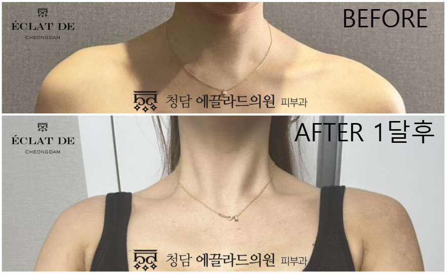 Trapezius Botox- Before & After from Eclat De