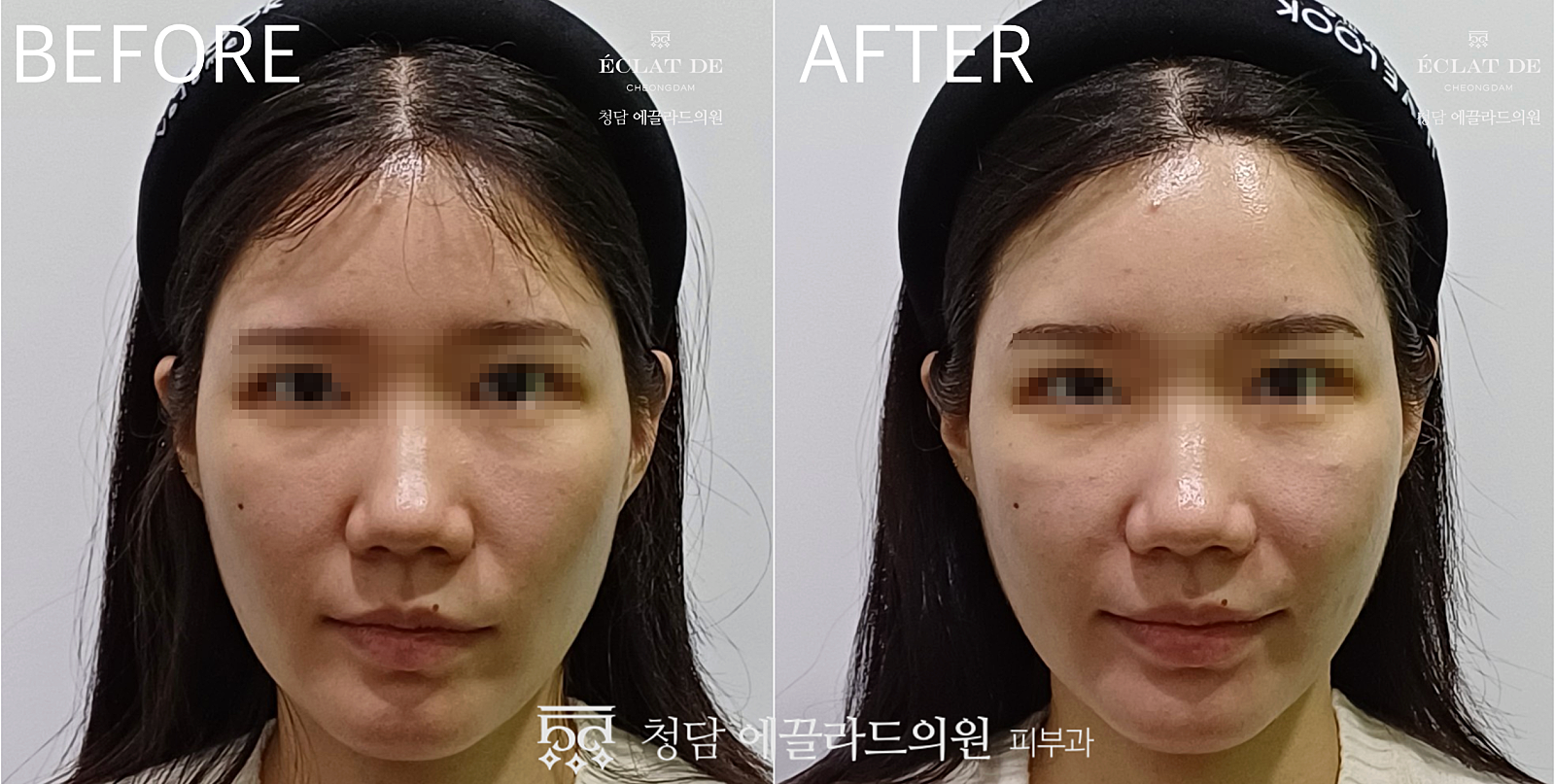 Belotero Revive - Before & After from Eclat De