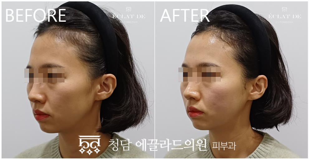 Titanium Lifting 80KJ – Before & After from Eclat De