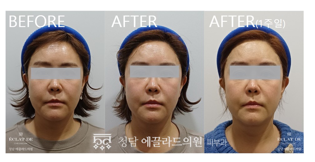 EMFACE- Before & After from Eclat de