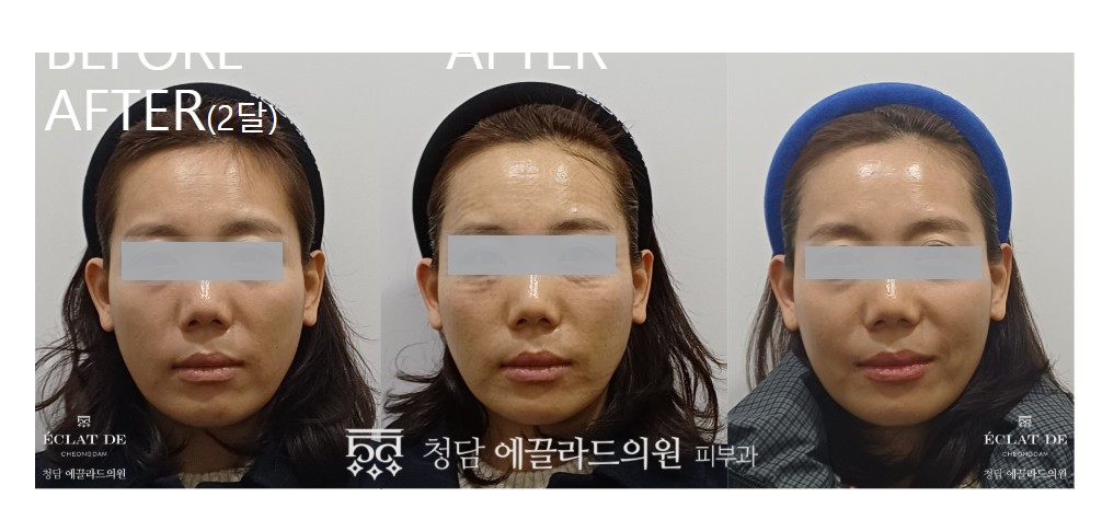 Re2O- Before and After from Eclat De