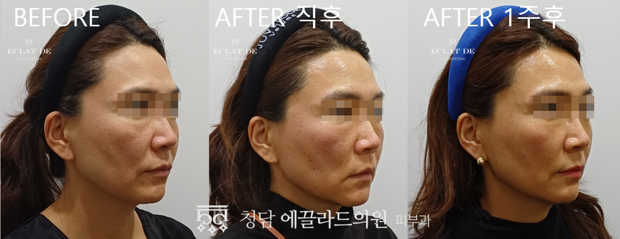 UltraClear- Before & After from Eclat De
