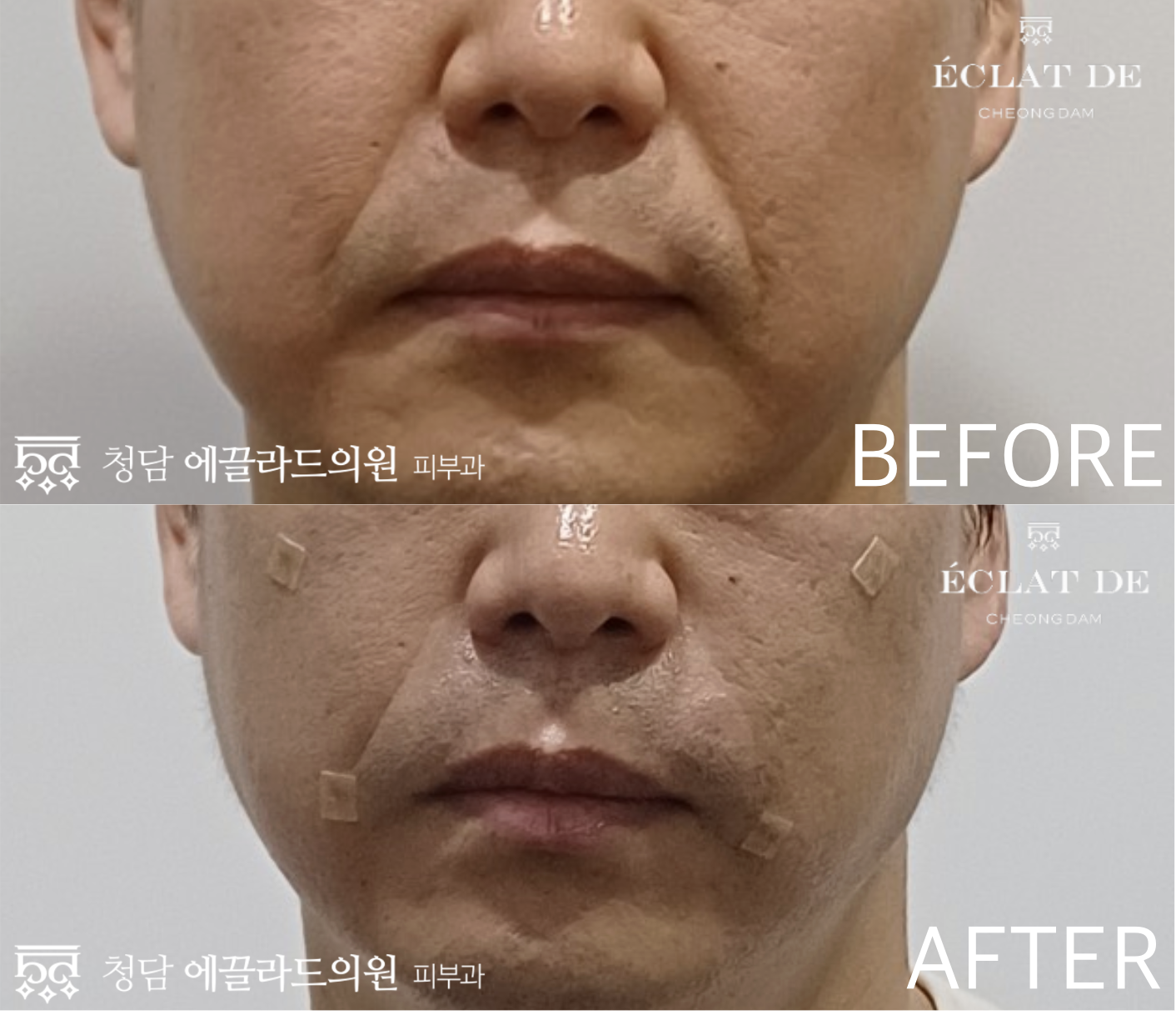 Hilowave- Before & After from Eclat De