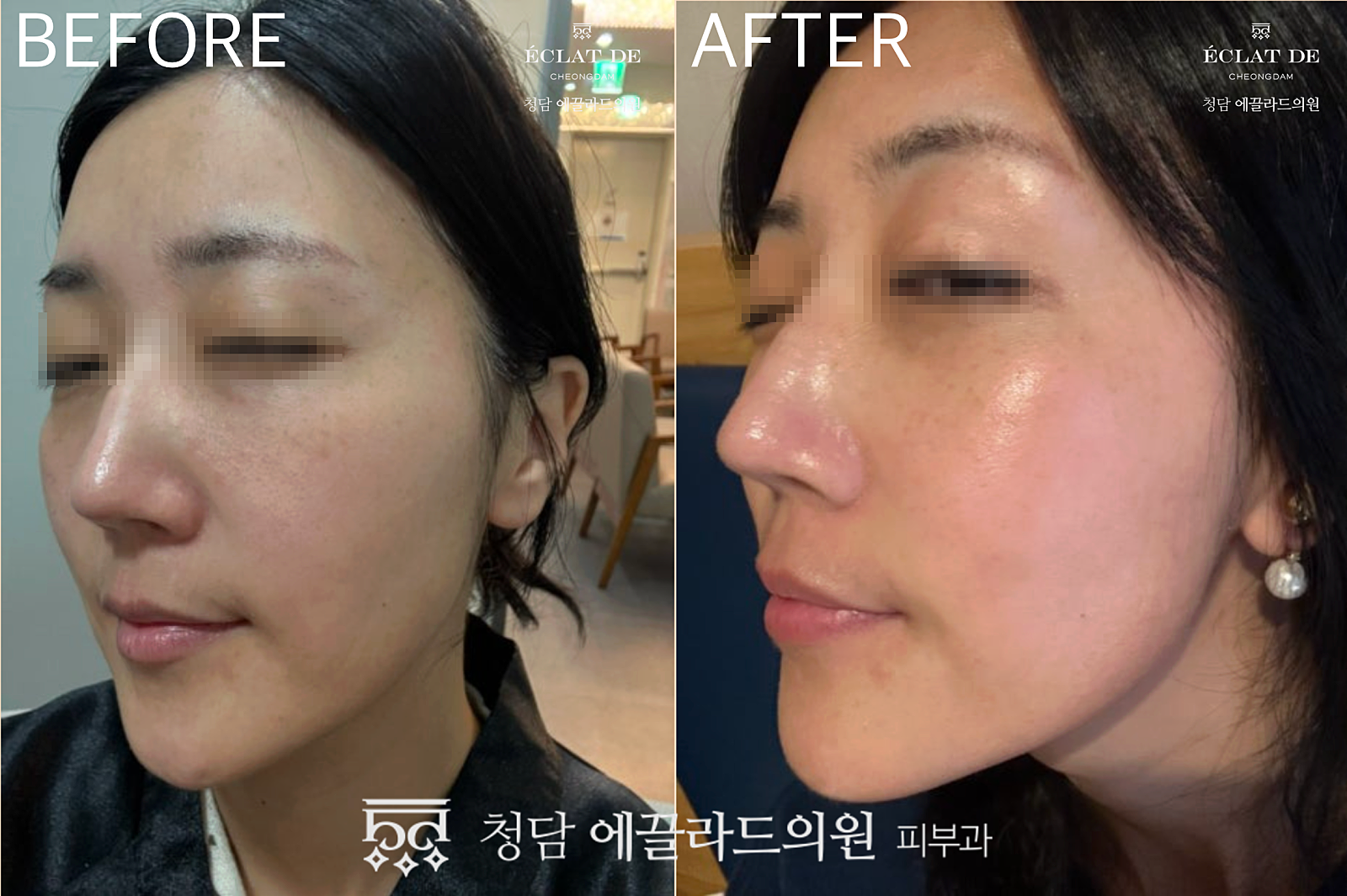 Re2O- Before and After from Eclat De