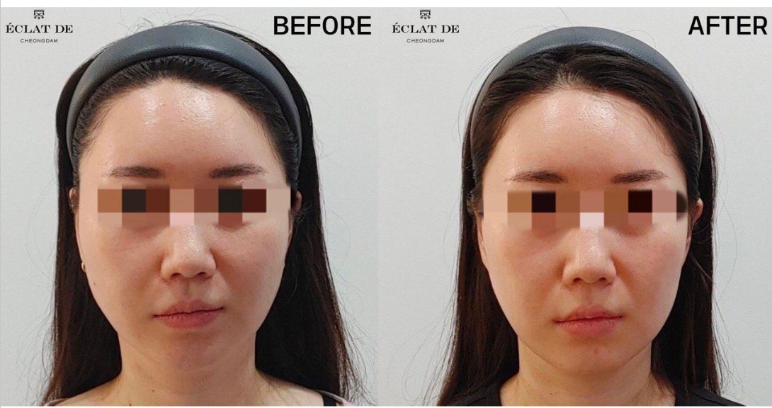 ONDA FACE- Before & After from Eclat de