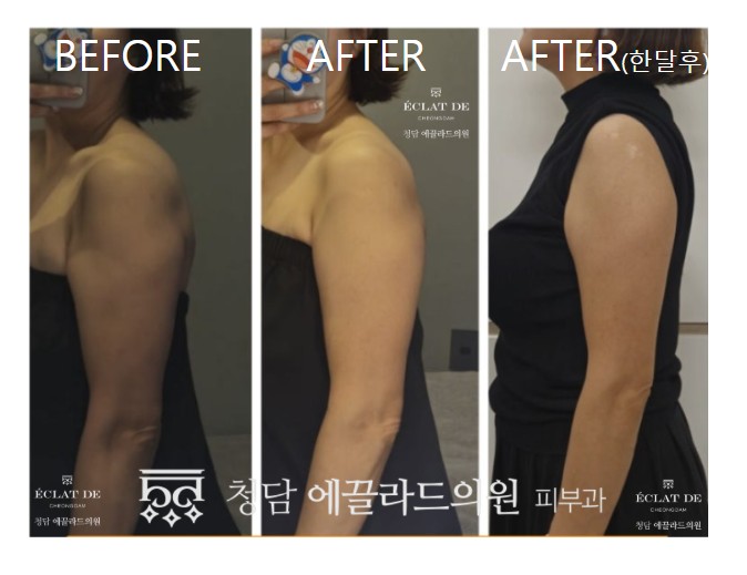 ONDA Body – Before & After from Eclat De