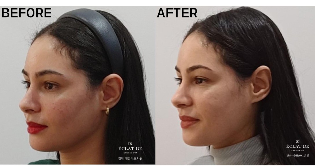 Juvelook Skin – Before & After from Eclat De
