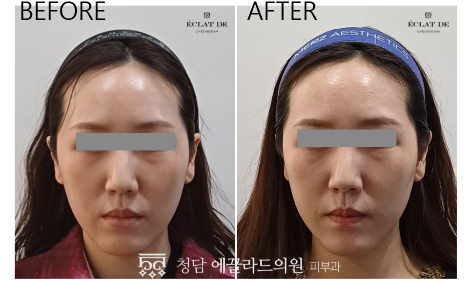 Ultracol 200 – Before & After from Eclat De