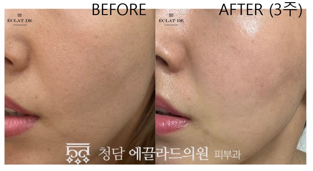Ellisys Sense – Before & After from Eclat De
