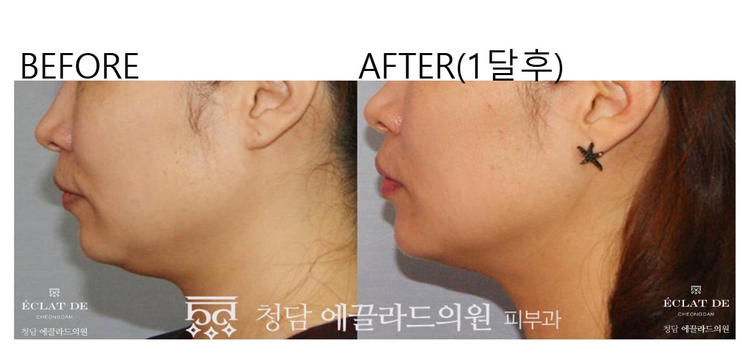 Ultherapy Prime – Before & After from Eclat De