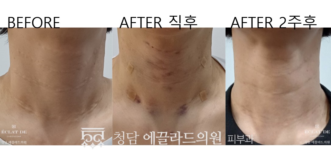 Radiesse – Before & After from Eclat De