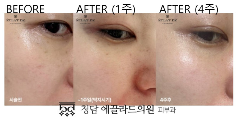 Dual Toning – Before & After from Eclat De