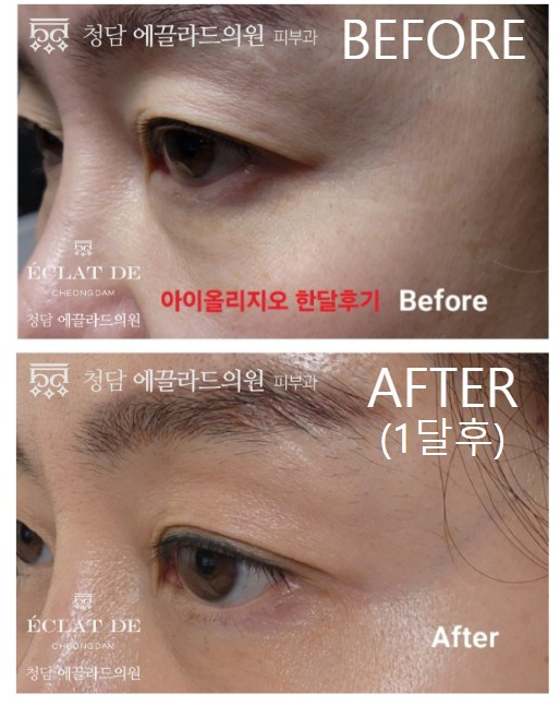 EYE Oligio X – Before & After from Eclat De