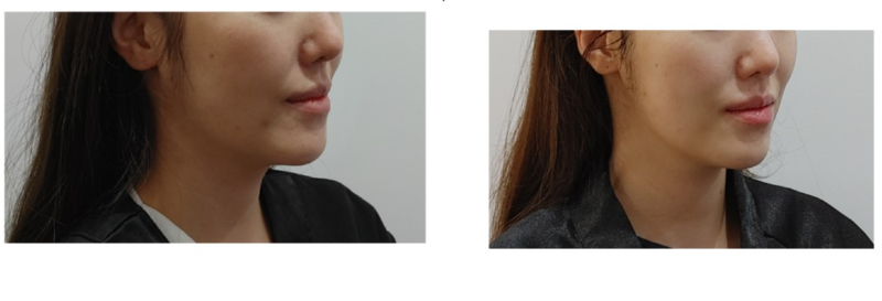 Thermage FLX – Before & After from Eclat De