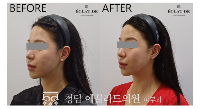 Titanium Lifting – Before & After from Eclat De