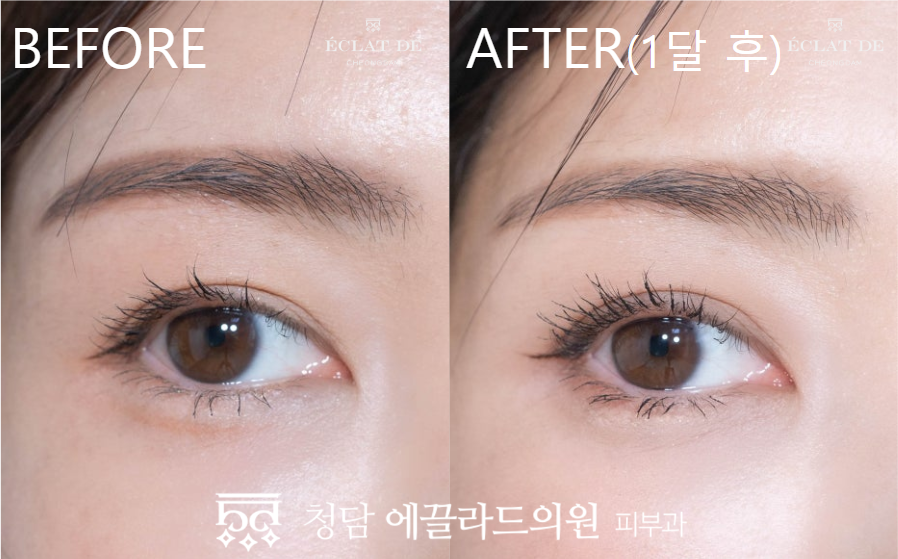 Eye Ulthera- Before & After from Eclat De