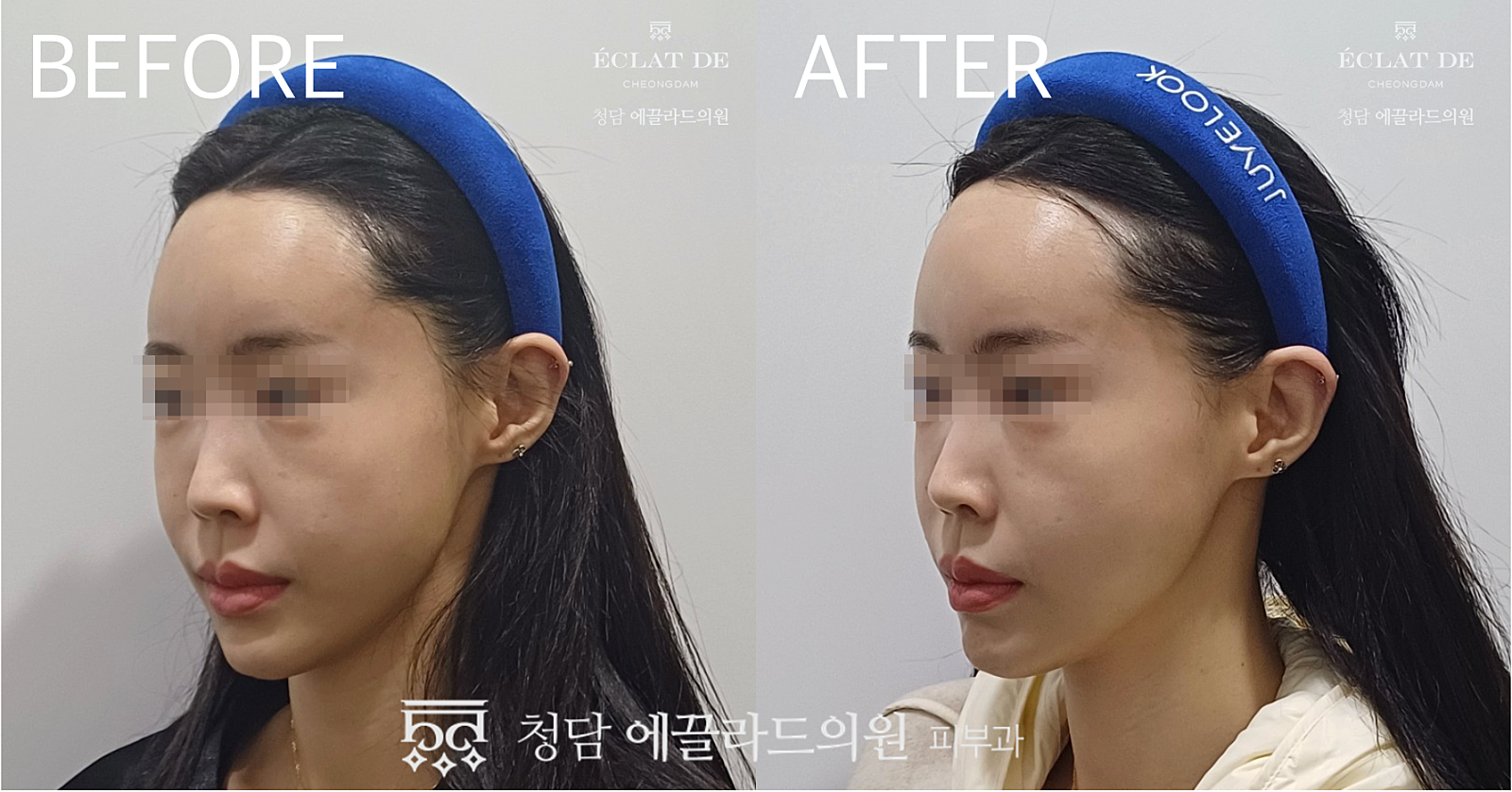 Geneo X- Before and After from Eclat De