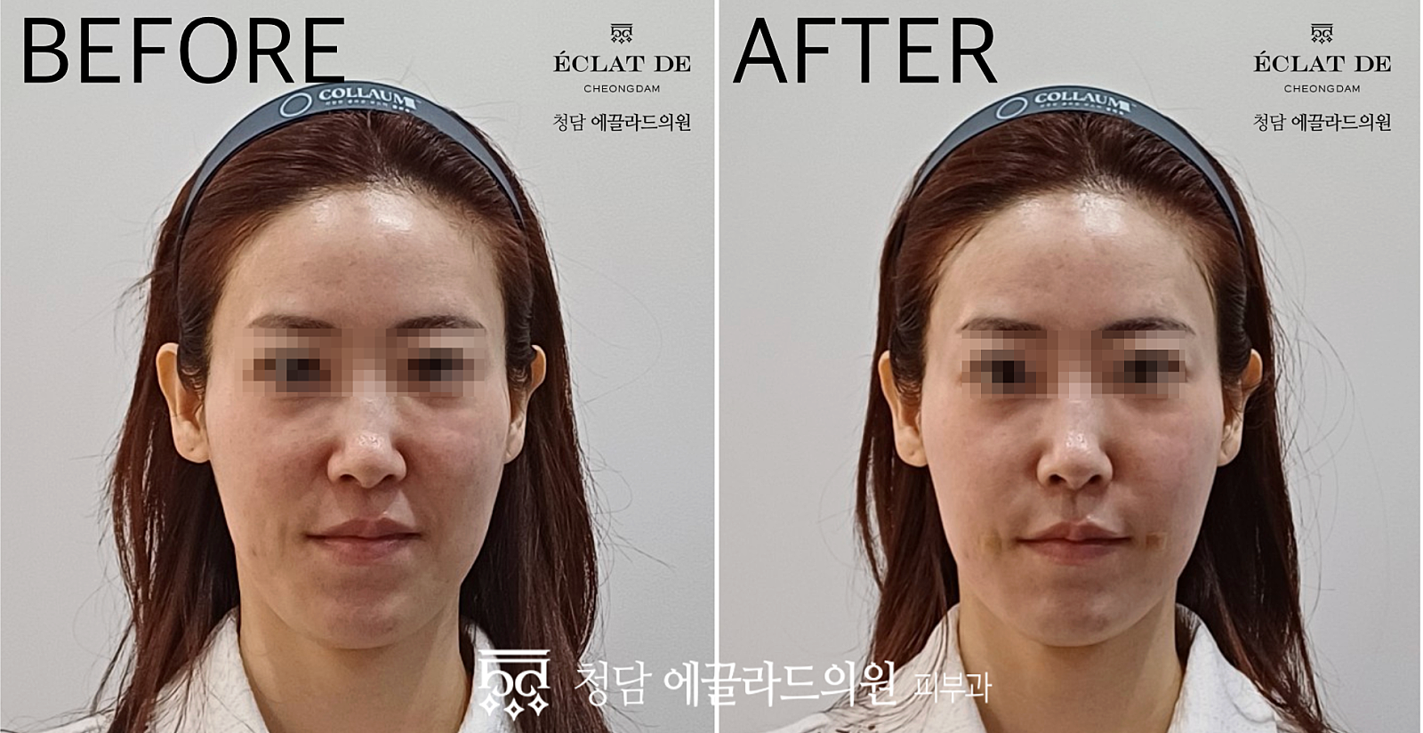 Juvelook Volume- Before & After from Eclat de