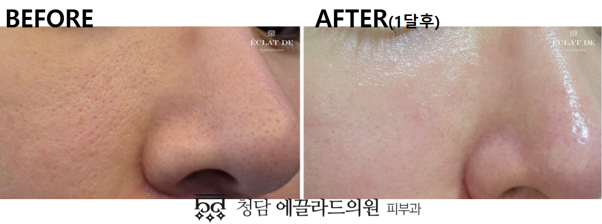 UltraClear- Before & After from Eclat De