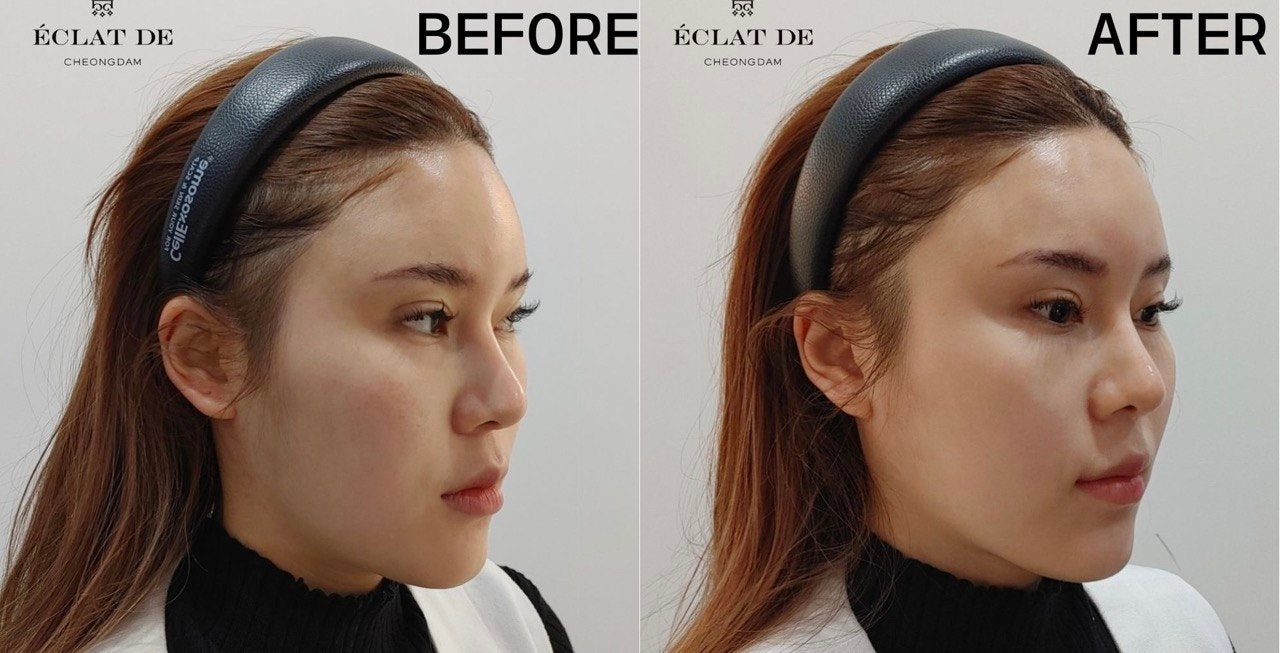 Rejuran - Before and After from Eclat De