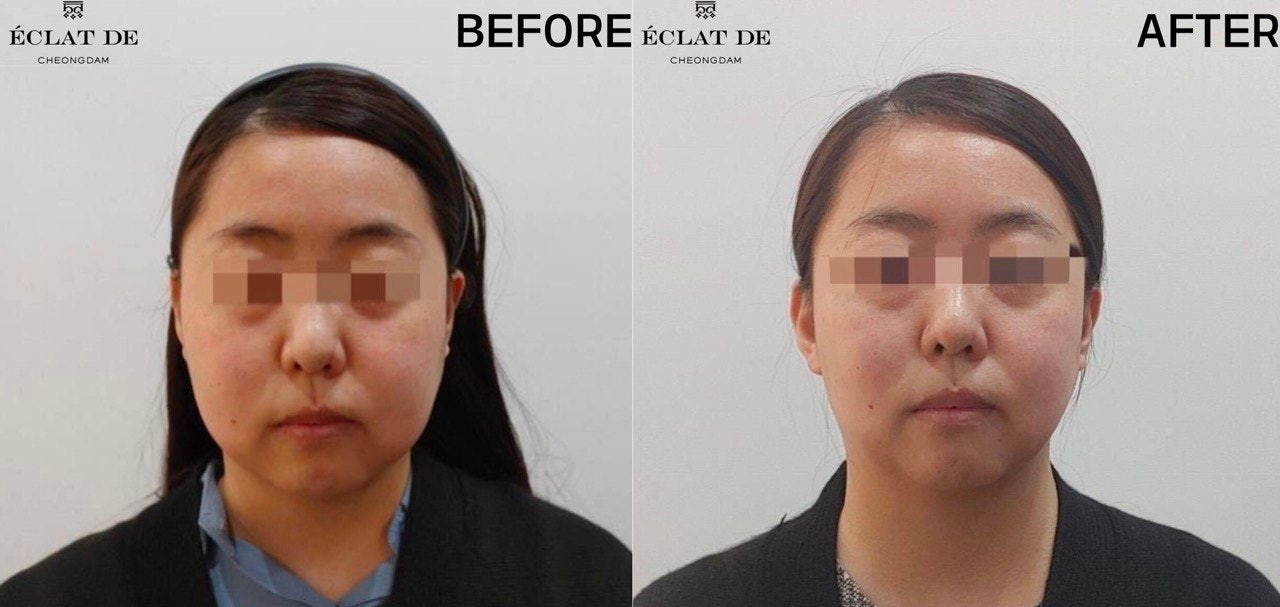 Doublo Gold - Before and After from Eclat De