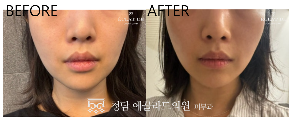 ONDA Lifting 60KJ - Before and After from Eclat De