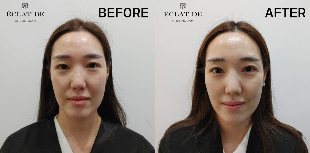 Thermage FLX 600 Shots- Before & After from Eclat De