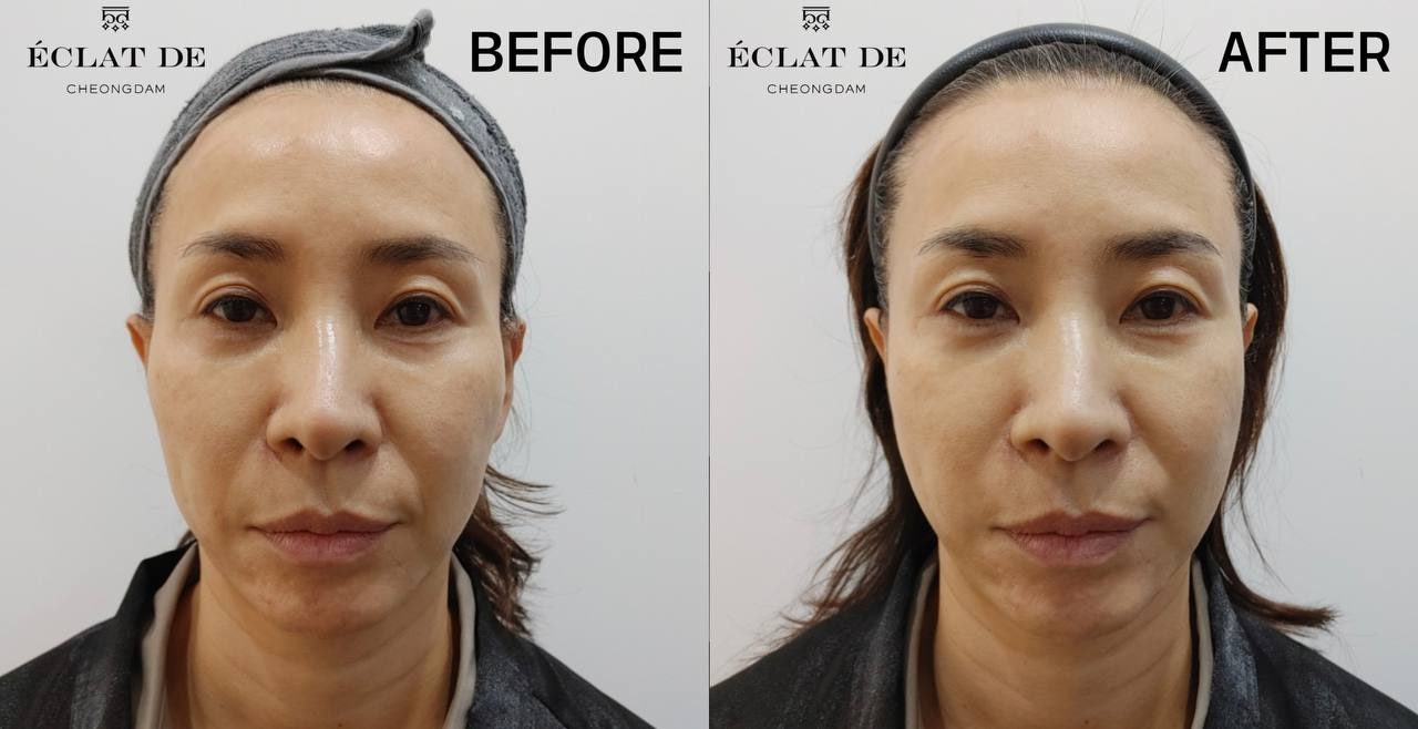 Oligio X 600 Shots– Before & After from Eclat De