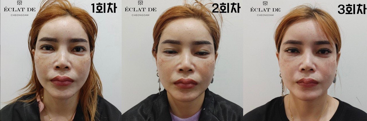 Dual Toning 3rd Session- Before & After from Eclat De