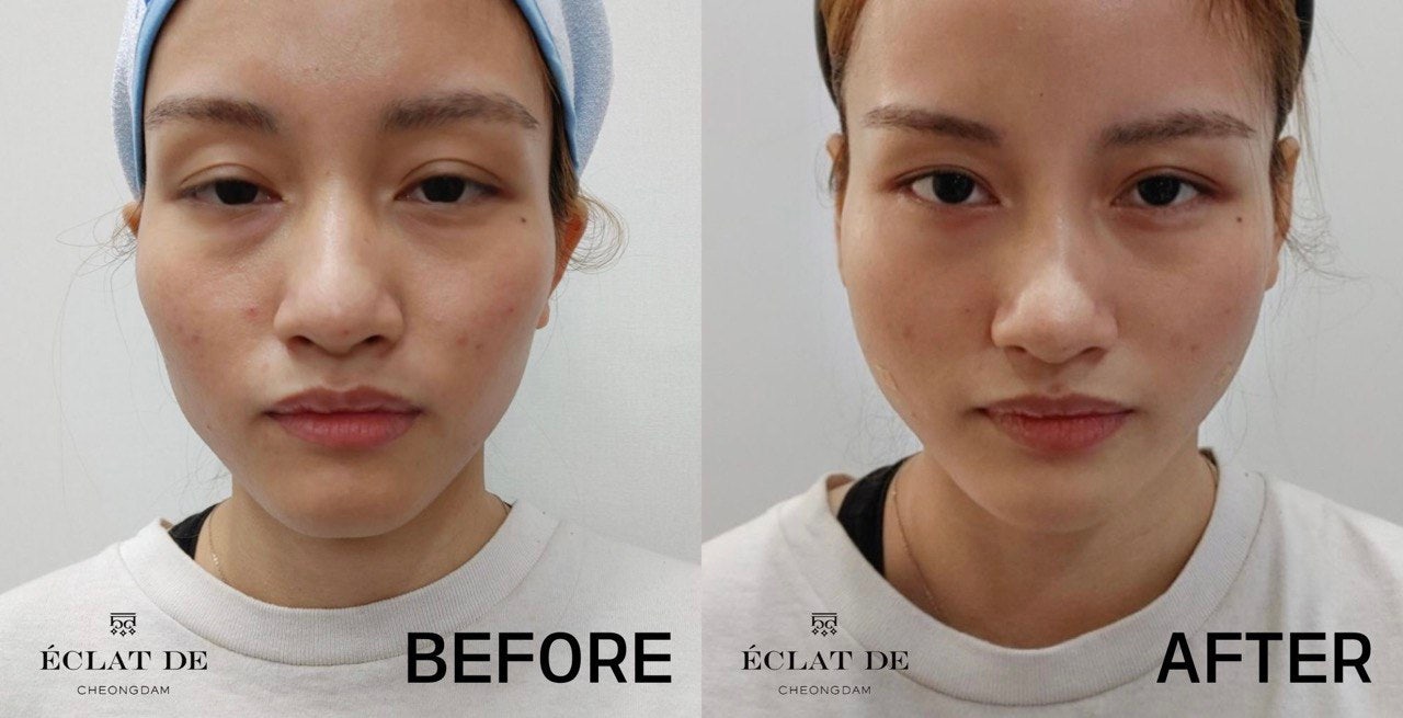 Cheek Fillers- Before & After from Eclat De