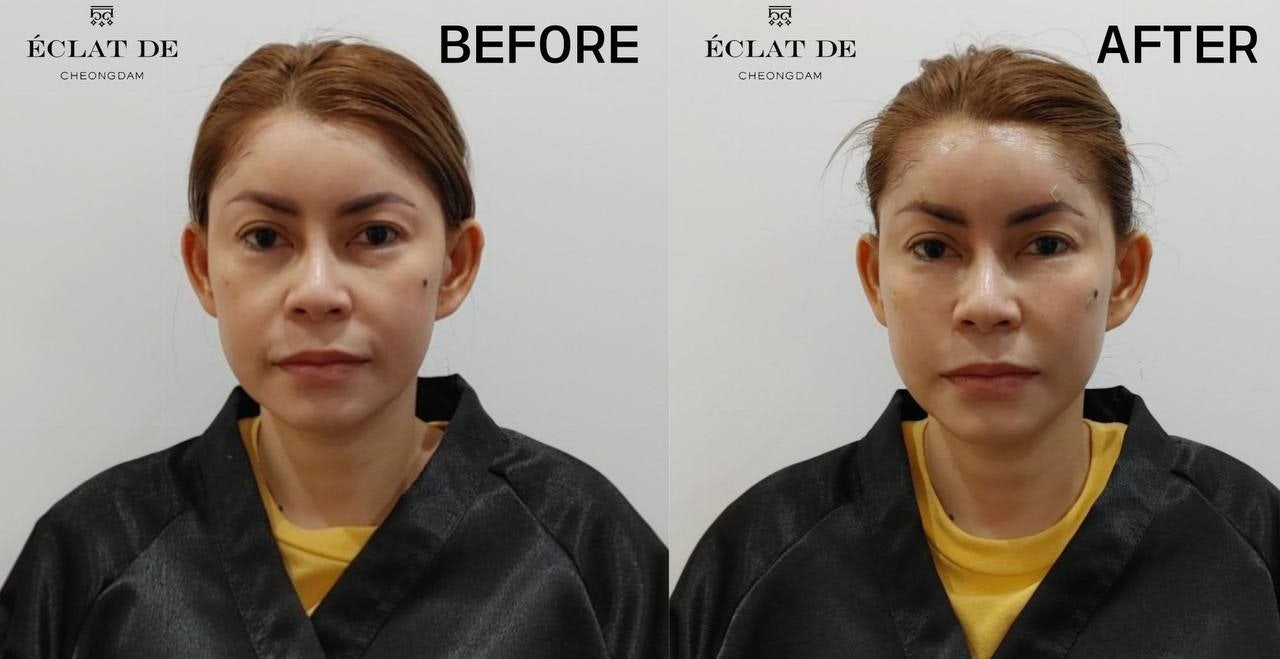 Full Face Filler & Botox - Before & After from Eclat De