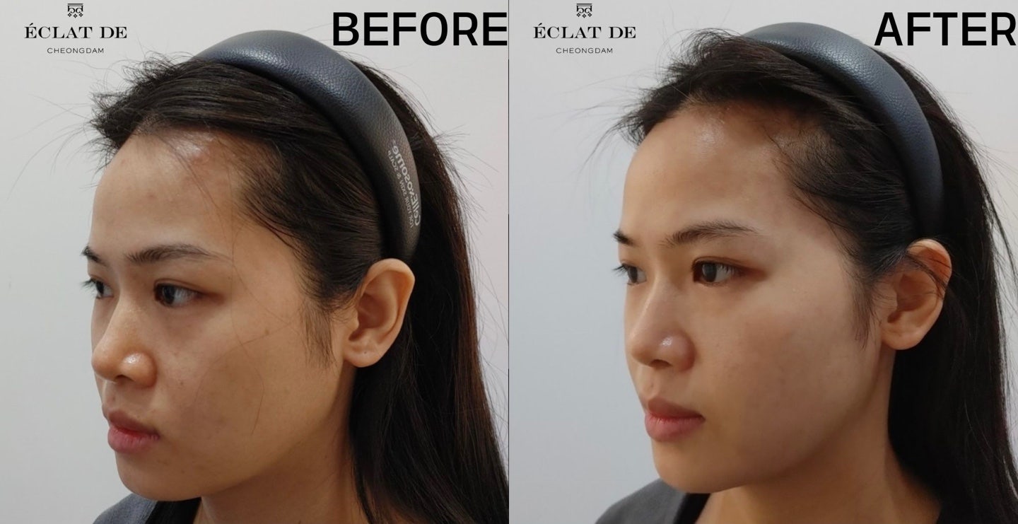 Rejuran - Before and After from Eclat De