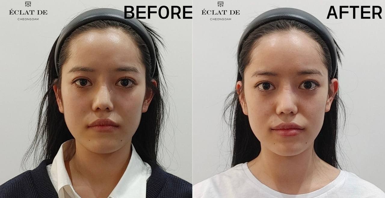 Lip Filler - Before & After from Eclat De