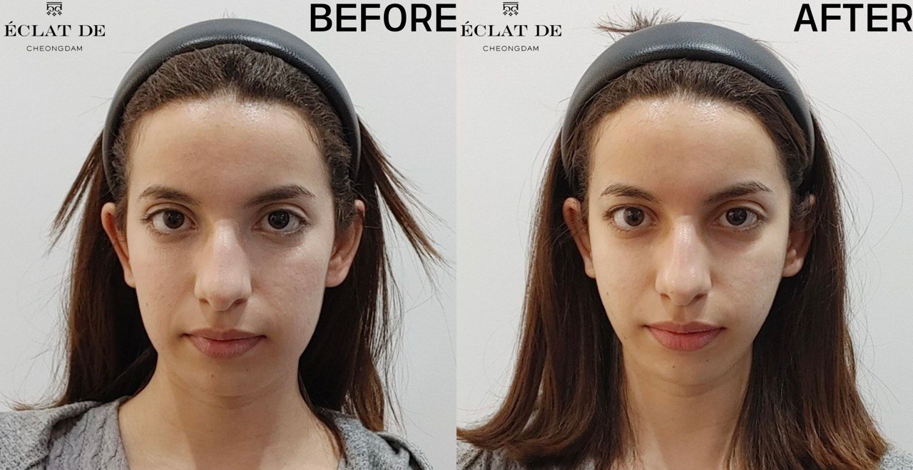 Ultherapy- Before & After from Eclat De
