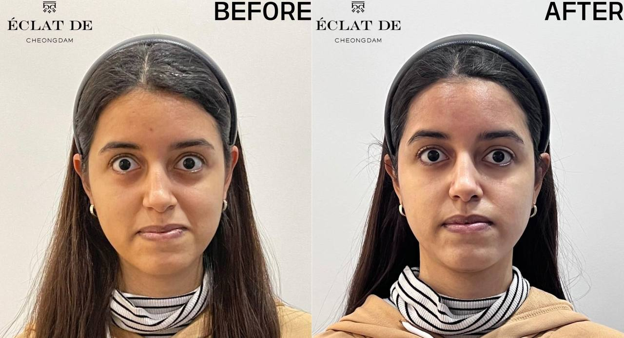 Aqua Peel- Before & After from Eclat De
