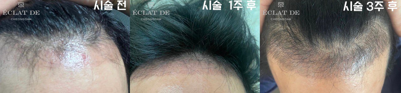 Hair TriCell- Before & After from Eclat De