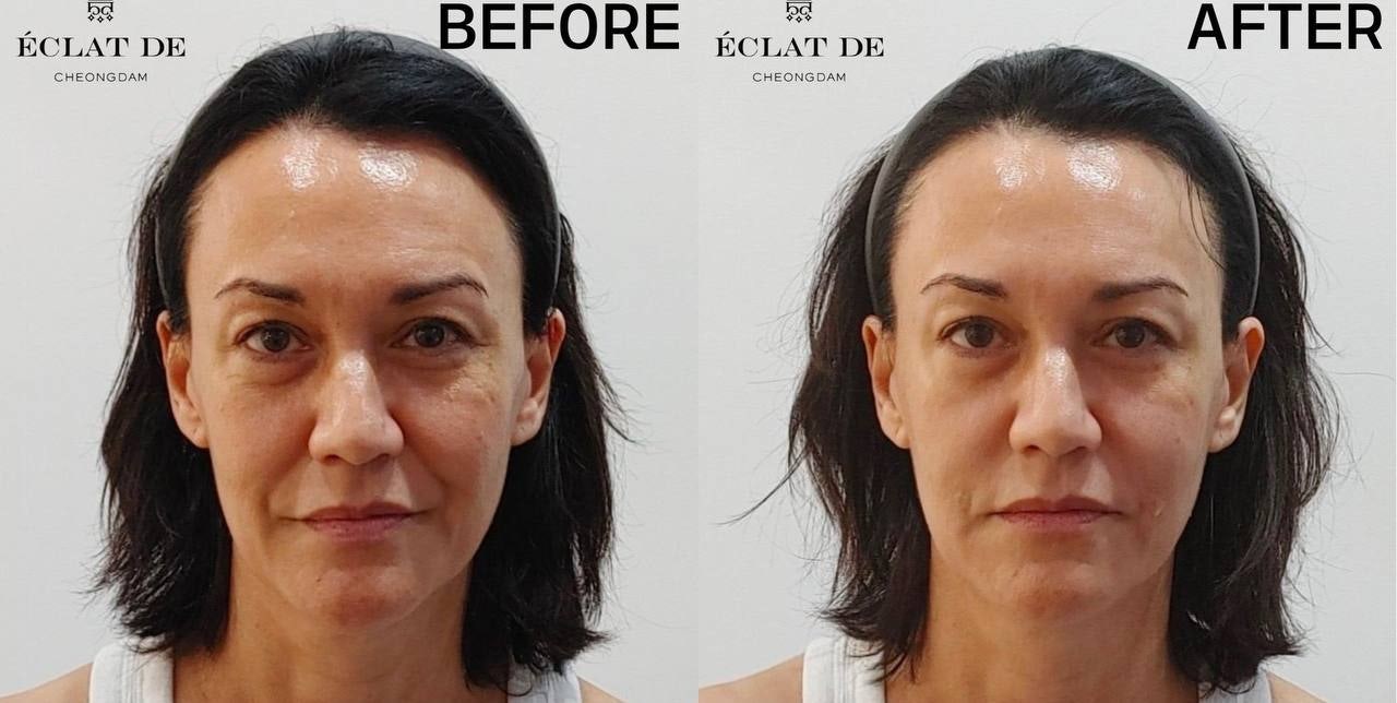 Belotero Smile Line Filler- Before & After from Eclat De
