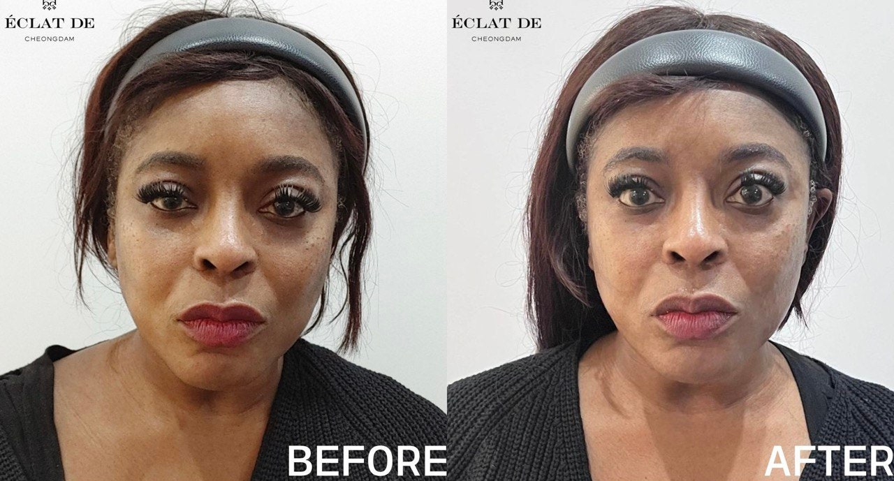 Skin Botox - Before & After from Eclat De