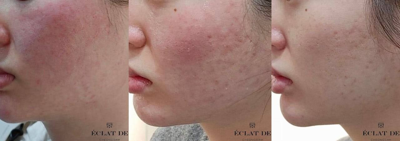 Ellisys Sense – Before & After from Eclat De