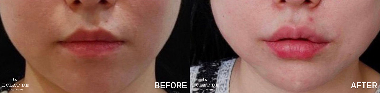 Lip Filler - Before & After from Eclat De